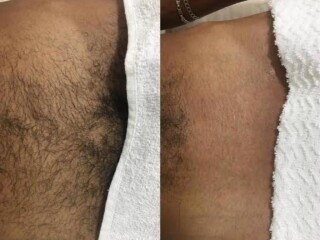 Depilaco ntima masculina maquina Bela Vista massagem e drenagem linftica no 329997809 